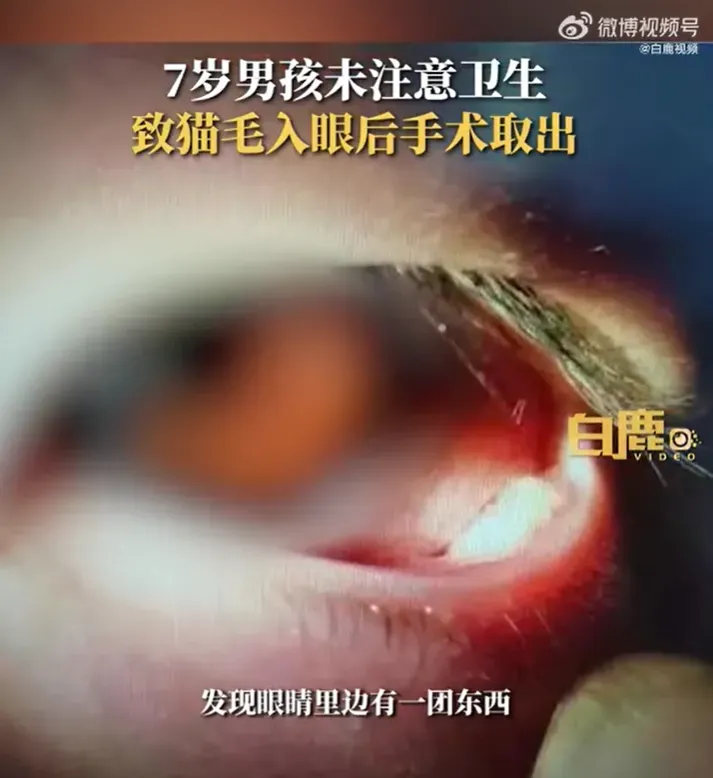 家裡有寵物要小心！男童眼睛突長「白色種塊」 就醫驚見元凶是「貓毛」