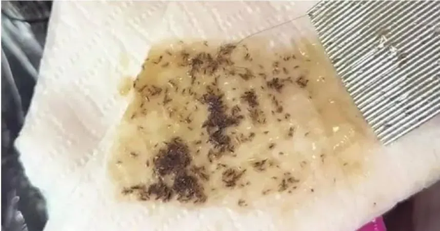 慎入！女頭髮多年住數千隻蝨子「在頭皮上爬行」　網：應該不只有我頭開始在癢吧