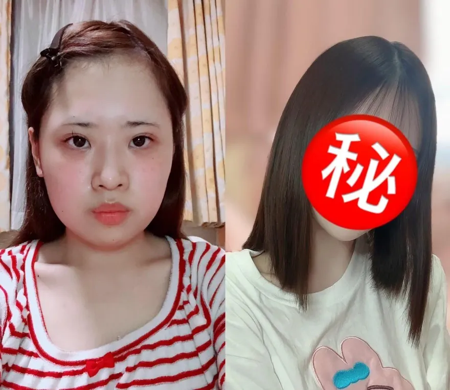 日本妹砸「超過173萬元」全臉大改造　整形前後對比照驚呆網：好可愛