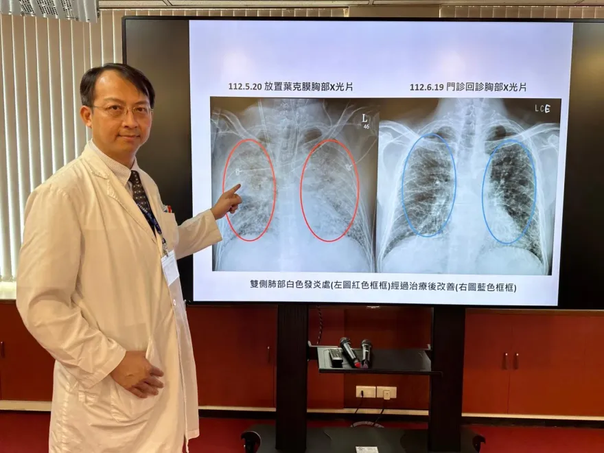 恐怖流感！64歲男呼吸困難變重症　中榮俯臥治療、葉克膜救命!