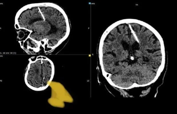 70歲老婦腦袋裡有根針竟然還活跳跳　衛生部門：可能為二戰時期殺嬰潮受害者