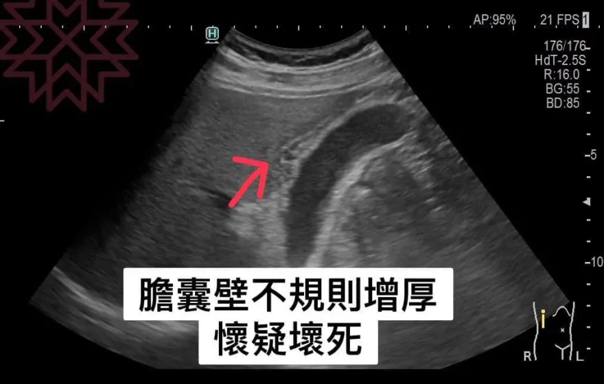 有圖慎入！壯男的膽「腫如士林大香腸」　醫照驚呼：不得了了