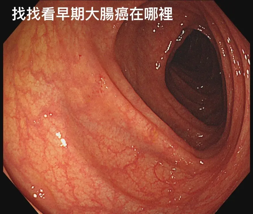 小息肉別輕忽！竟是「0期大腸癌」　醫PO照：大家一起抓鬼
