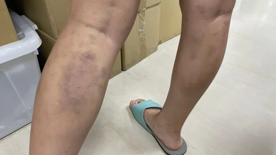 台中女主管工作太累去「撥筋」竟腫如家暴　醫師示警：8種人千萬別去