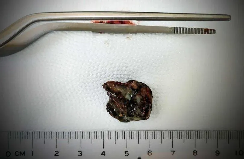 鼻塞10多年超崩潰　醫驚見「巨型黑硬塊」塞爆鼻中膈…挖到滿頭汗