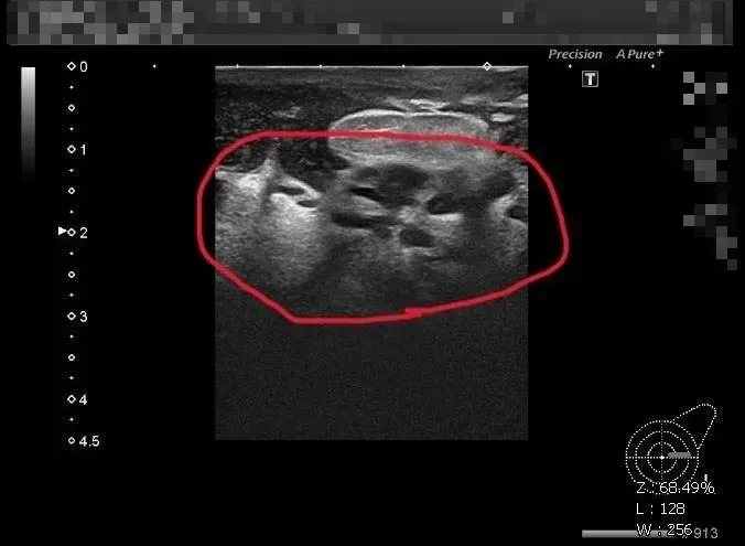 少婦乳房冒硬塊腫痛潰爛！竟染「古老結核菌」醫：150年不到600例