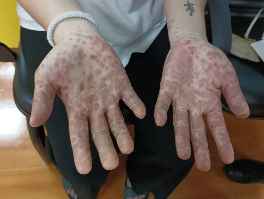 快訊/傳染力超強！腸病毒疫情上升　與歷年相比「近十年同期最高」