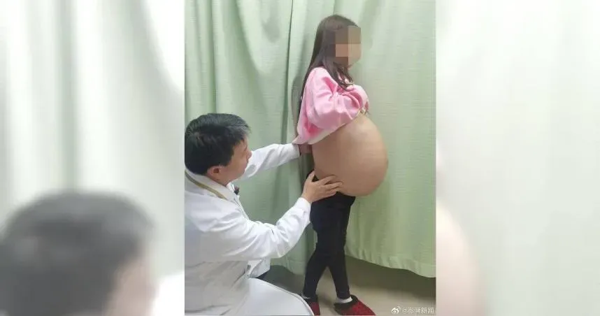 腹腔3/4空間占滿「脂肪瘤」　肚子比臨盆孕婦還大！手術4小時腫瘤竟重達23公斤