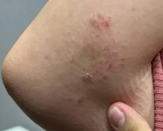 28歲女皮膚紅癢難耐　濕疹反覆不癒！規律服中藥…經期不順也有效