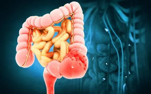 每天44人罹大腸癌！他切息肉後未追蹤　4年後回診慘罹癌