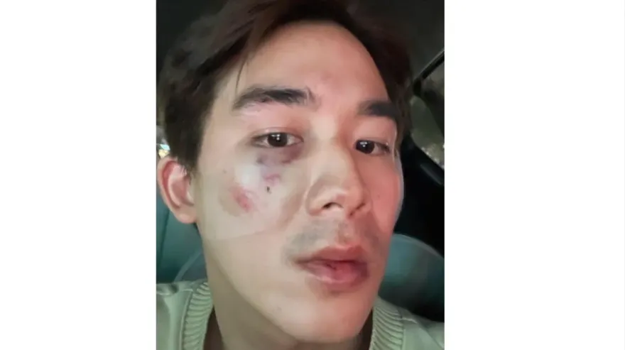 李博翔街頭被打！曝傷勢「左腦腫大神智不清」　女友護愛也遭毆