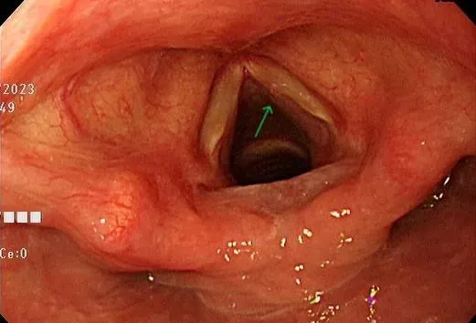 6旬女沙啞2個月以為胃食道逆流！內視鏡檢查驚見「聲帶瘜肉」