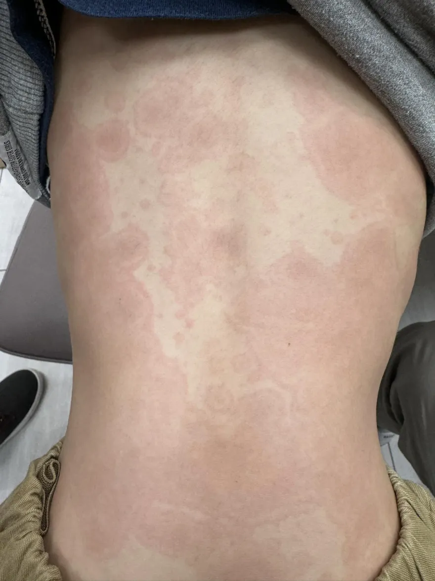 小學生發燒咳嗽3天！驚見「背部爬滿紅斑」　醫示警：是黴漿菌感染