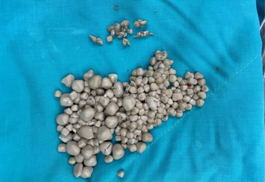 驚！太可怕！20歲女手搖飲當水灌　腎臟竟取出「300多顆小饅頭」