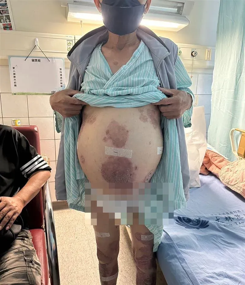 不是孕婦！肝癌男「滿肚腹水」只能換肝　因「死去的外國人」器官捐贈重生