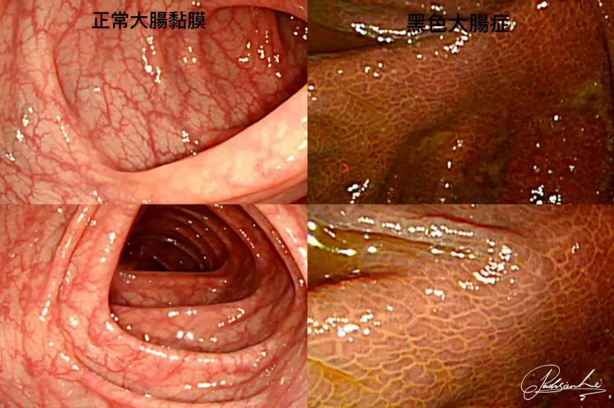 大腸鏡一照大腸都黑色的？竟是「黑色大腸症」醫揭：與排便狀況有關