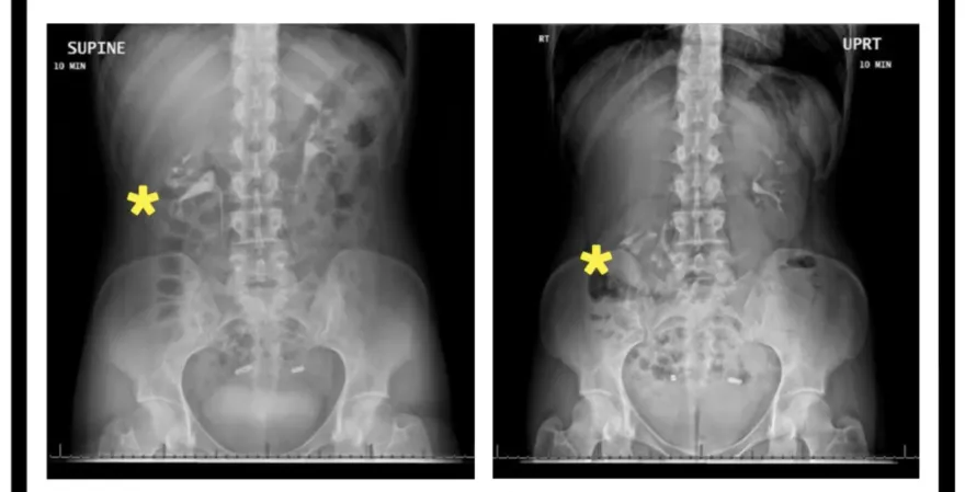 女高中生腰痠又頻尿　一照腎臟超音波驚見「腎下垂」！醫曝：纖細身材是原因