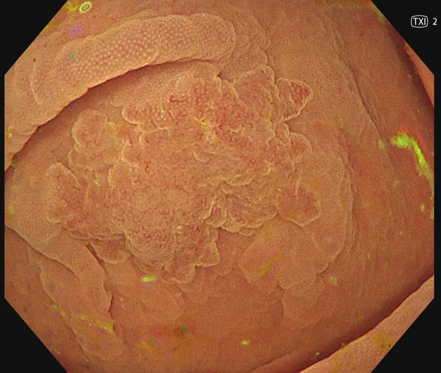 才照完大腸鏡正常！「1年後驚見息肉」醫揭驚人真相：當心大腸間隔癌