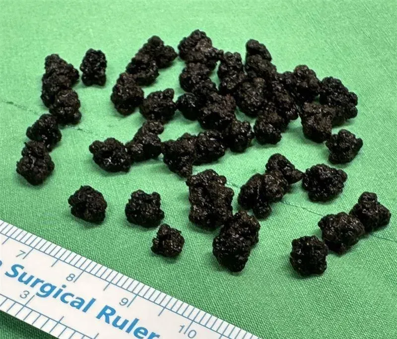 7旬翁腹痛、腰痛血尿「膽結石」開刀！醫護驚：好像高山茶葉