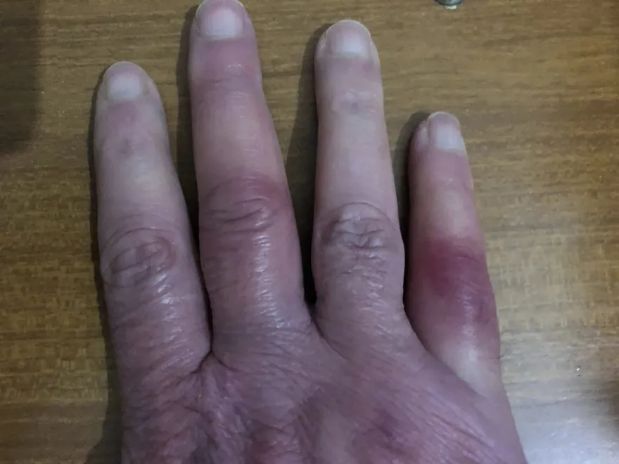 騎機車手冷吱吱？低溫又碰水小心凍瘡　醫：保暖用襪子、手套絕不可以濕