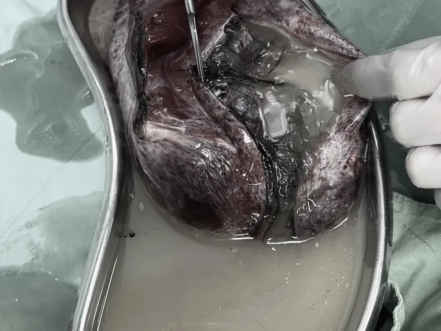 慎入！她腹部劇痛就醫挖出「一坨20cm肉球」　醫驚呼「還有頭皮＋長髮」嚇傻