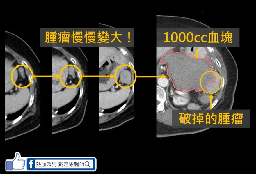 70歲婦後腹腔大出血送醫　竟是腎臟腫瘤破裂！ 醫曝可能原因：推拿要小心