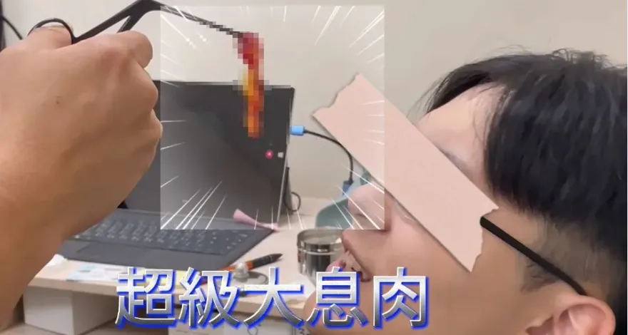 影/慎入！「8公分長鼻息肉」取出　20歲男眼角泛淚「可以呼吸的感動」