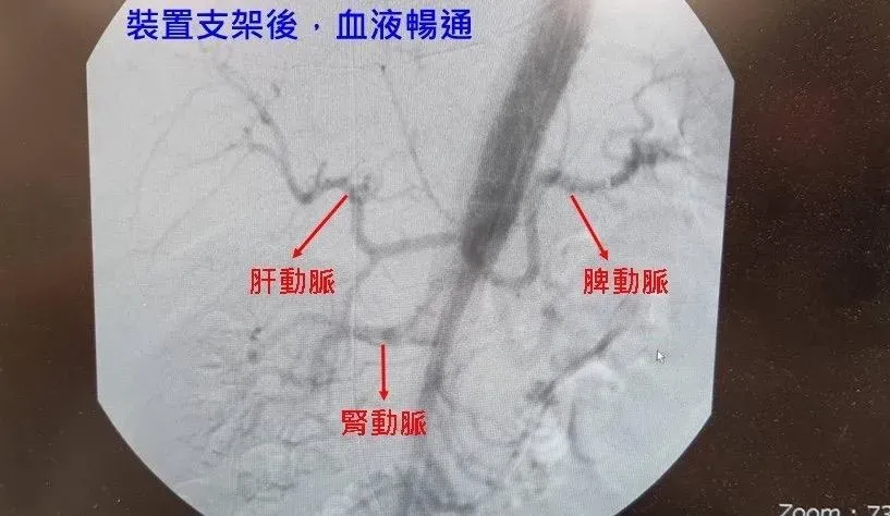 43歲男子肚子劇痛　就醫一看竟然是「主動脈剝離」惹禍！