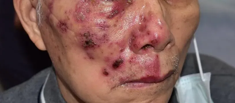 7旬嬤皮膚乾癢痛不欲生！檢查竟是「帶狀皰疹」惹禍