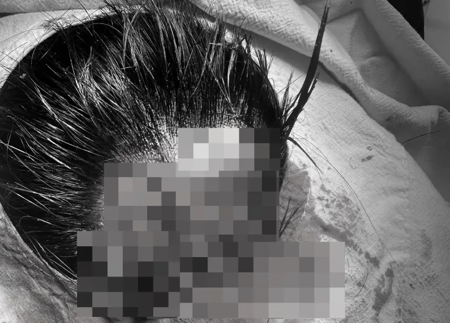 驚人傷勢曝光！Toyz頭破一個大洞「縫了至少10多針」　網怒批「要殺人是不是？」