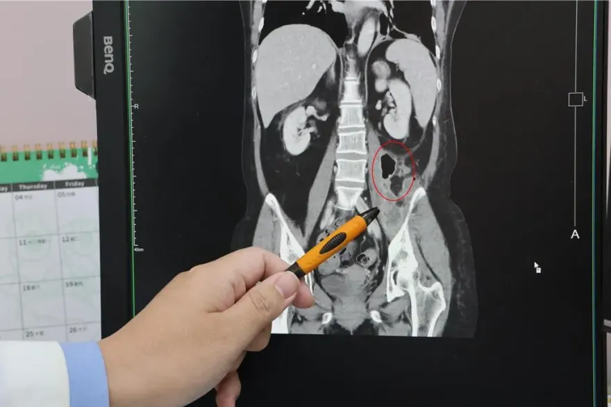 工人喝酒「急性背痛」！一查竟細菌感染「腰大肌膿瘍」嚴重恐敗血症