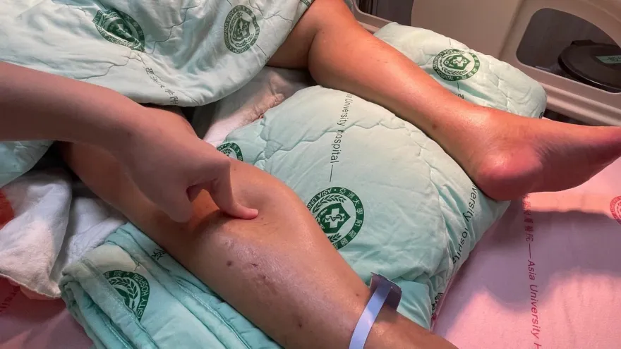 偉大的模仿者！輕熟女「腹痛、下肢水腫、腦病變」罹狼瘡性腸繫膜血管炎