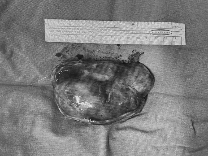 有圖！老婦後腿摸到腫塊...7天後「悄悄長大了」　化驗結果竟是惡性肉瘤