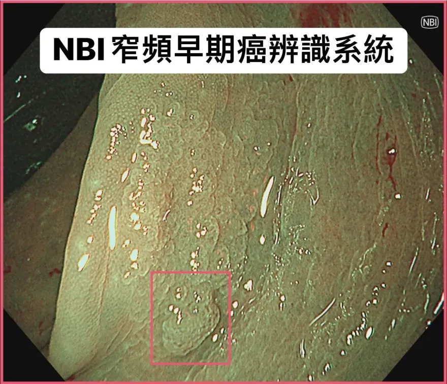 1瘜肉25%恐變大腸癌！35歲女檢出2cm鋸齒狀瘜肉！醫曝：糞便潛血恐檢查不到