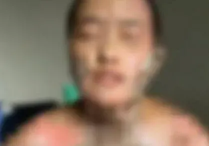 渣男潑妻子滿身酒再點火！她全身盡毀淚訴「他看我被燒還在笑」