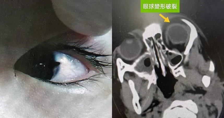 4歲女童美工刀誤認成筆！眼球遭「美工刀刺破」…眼白被劃開