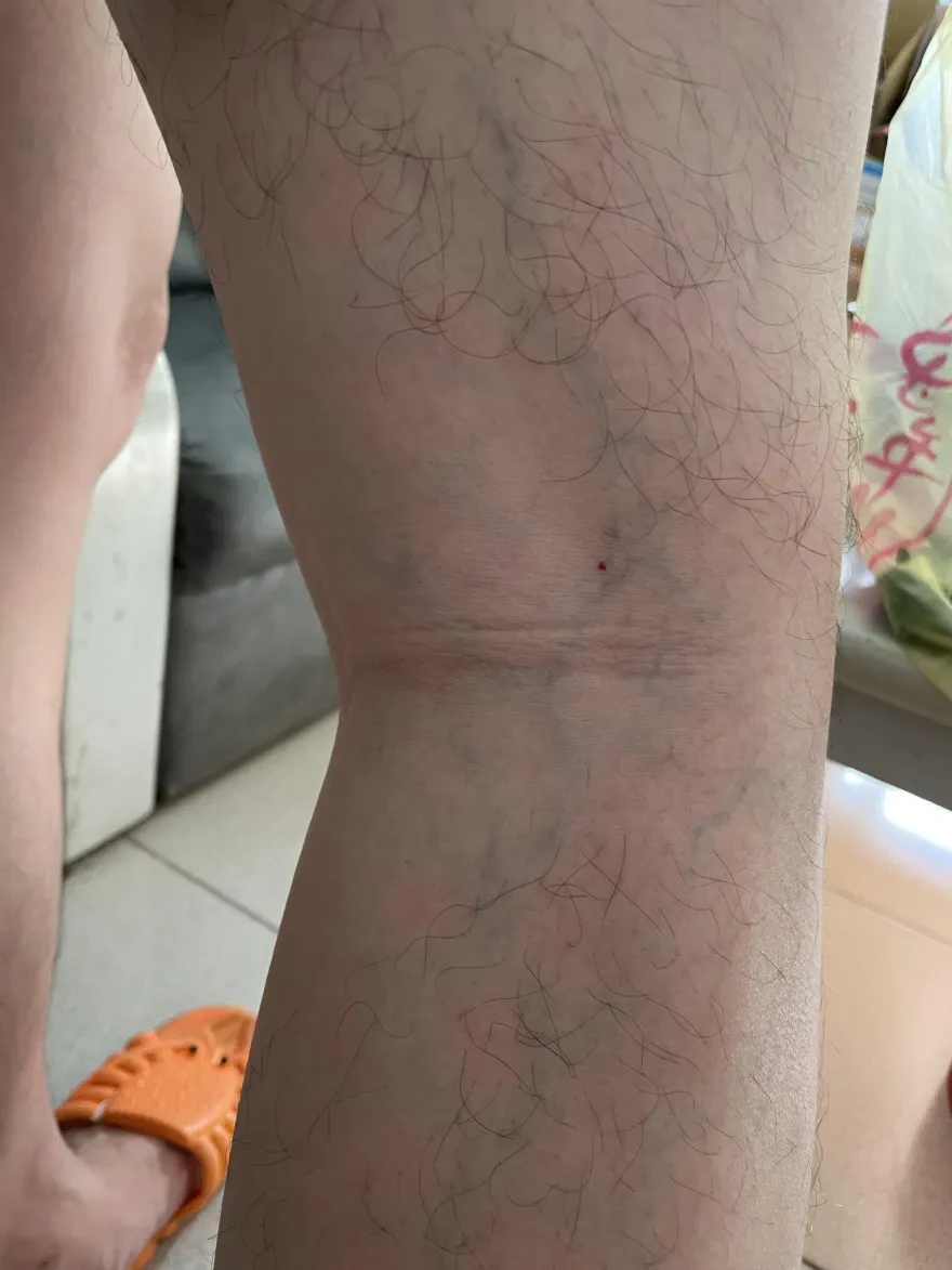 長時間站立開刀　小腿爬滿青綠色蚯蚓！醫師自曝：無法避免...
