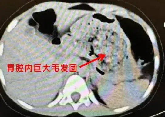 5歲女童腹痛難耐！醫從胃裡取出「一大坨毛髮」　確診為「長髮公主症候群」