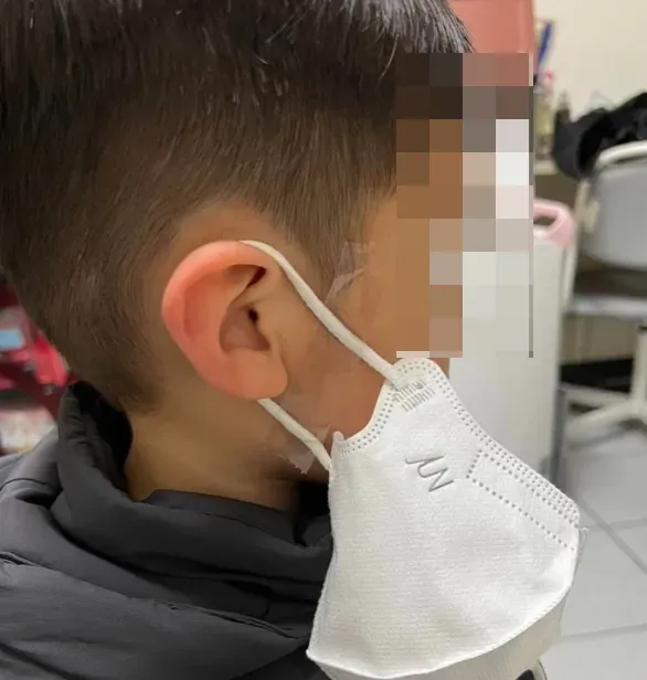 孩子上學遭強硬「貼」口罩！臉頰現兩紅斑　母心疼問：一定要戴？