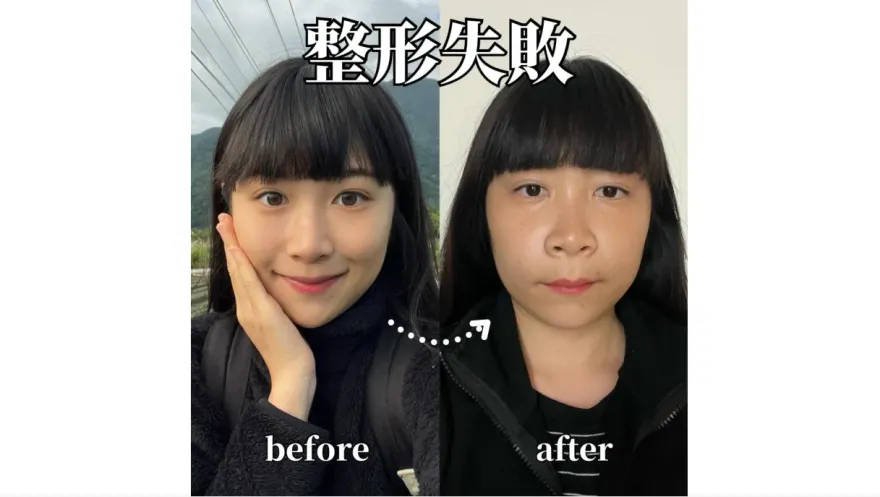 NanaQ臉腫到變形！自爆「整形失敗」公開術後照　嘆：完全不想照鏡子