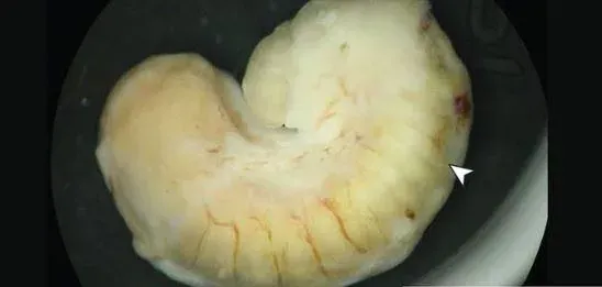 她眼球長「腫塊」拖2年才就醫！驚見寄生蟲蠕動　疑吃鱷魚肉感染
