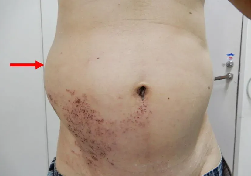 皮蛇纏腰！他右腹腫脹「以為長了壞東西」竟是帶狀疱疹併發症作怪
