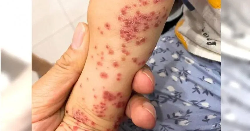 同學染腸病毒全班停課！媽怨「長一點點疹子嚴重嗎?」　醫曬一照網氣炸
