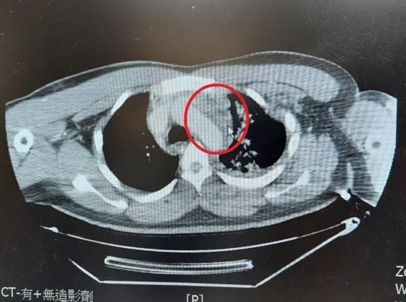 車禍撞擊「主動脈剝離」致死率極高！8成到院前離世