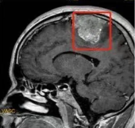 32歲男穿不住夾腳拖鞋！　一檢查竟是「6公分腦瘤」惹禍