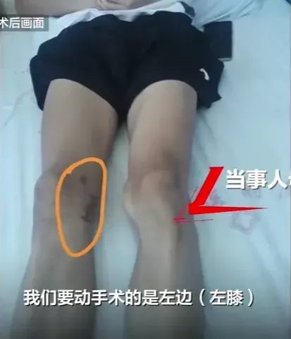 17歲少年左膝長骨瘤！醫師手術竟離譜「錯切右膝」　院方：願賠償協商
