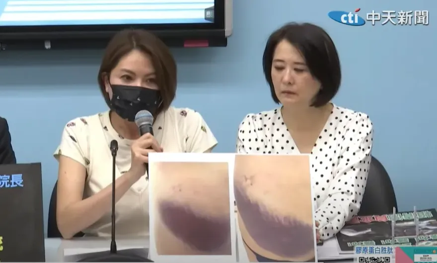 影/陳菁徽痛哭曝傷勢照片！臀部、腰部遭鍾佳濱魔爪「超大片瘀青」怵目驚心