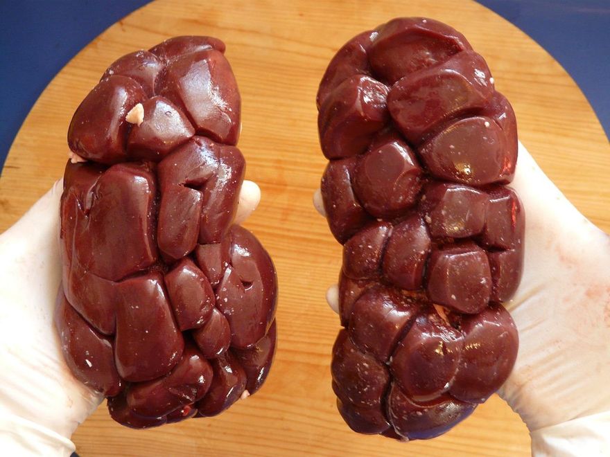 愛吃重口味小心腎壞掉！疲勞、水腫、高血壓都是警訊