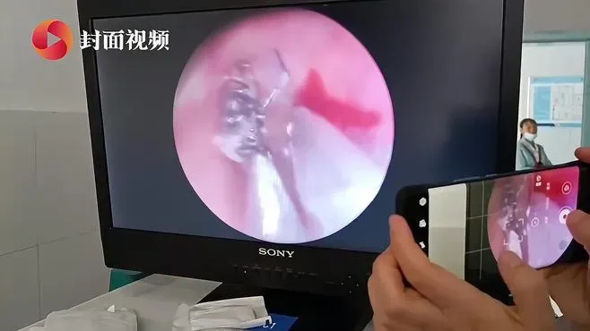 影/頭暈耳鳴2週求診…醫一照耳鏡手抖了　「活蟲在爬」鼓膜上還有「白芝麻」