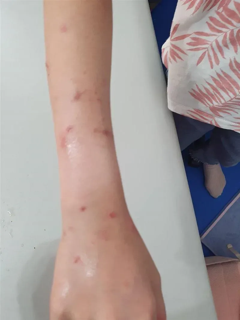 「雙臂都是傷」還被老師逼鞠躬道歉！新竹明星小學爆霸凌　劉彥伶要求嚴正處理